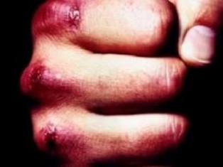 Man beats mother-in-law on Christmas Eve in Armenia