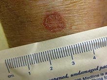 Кожное заболевание может быть истинной причиной рака