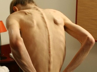 Ученые: Аутизм и анорексия похожи