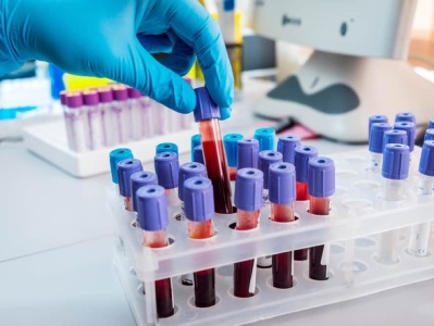 482 new COVID-19 cases reported in Armenia, 11 new deaths 4 of which from other diseases