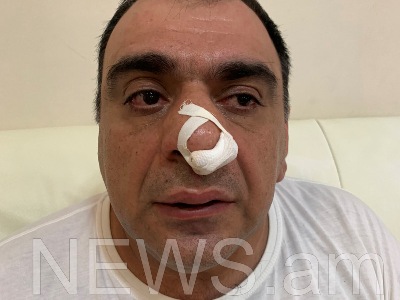 Մոսկվաբնակ գործարարը պնդում է, որ Երևանում Խաչատուր Սուքիասյանի եղբայրն ու թիկնապահն իրեն ծեծի են ենթարկել (ֆոտո)