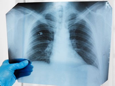 AI identifies patient's race from X-rays