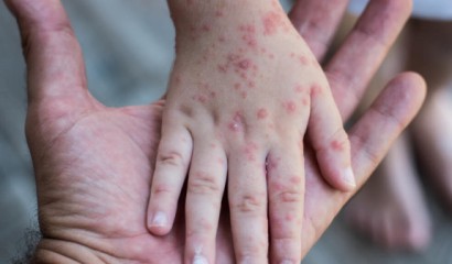 Минздрав: В Армении не зафиксировано случаев заражения оспой обезьян