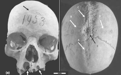Woman who lived 1,300 years ago was trepanatized in Europe