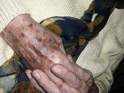Փրկարարները գտել են Չուվաշիայի 88-ամյա բնակչին, որը 2 օր շրջել է անտառում