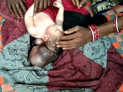 Three-headed baby born in India