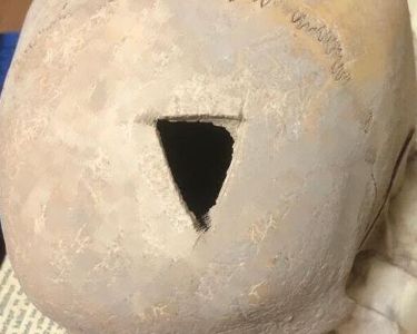 3,200-year-old skull with traces of trepanation found in Van