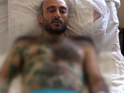 Раненого вследствие применения полицией спецсредств Есаи Карамяна вновь прооперировали