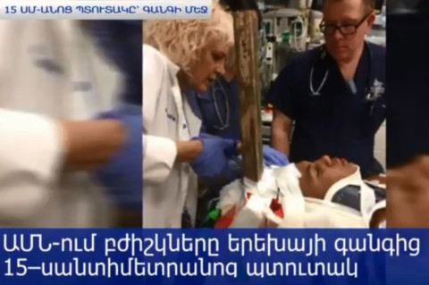 ԱՄՆ-ում բժիշկները երեխայի գանգից հանել են 15–սանտիմետրանոց պտուտակ