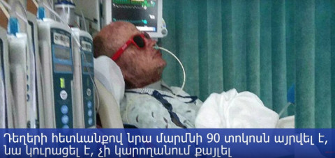 Հակաբիոտիկների պատճառով տղամարդը նմանվել է իրական «զոմբիի»