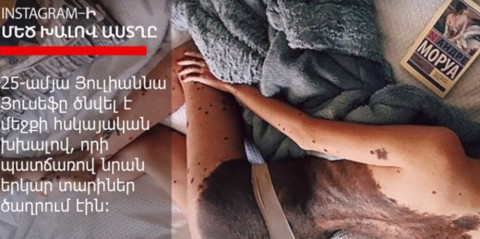 Դալմատինի մաշկով աղջիկը դարձել է Instagram-ի աստղ