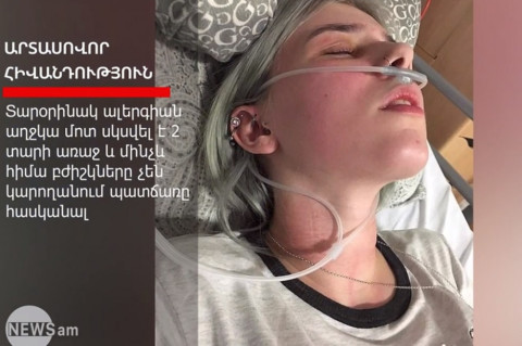 «Ալերգիա՝ կապտուկի տեսքով». 17–ամյա աղջիկը ստիպված է բոլորին համոզել, որ իրեն չեն ծեծել