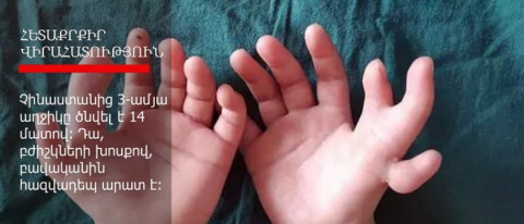 14 մատով ծնված աղջկան վիրահատել են
