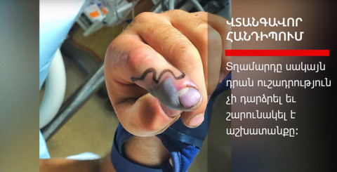 Տղամարդու մատը բոժոժավոր օձի խայթոցից հետո փուչիկի պես ուռել է