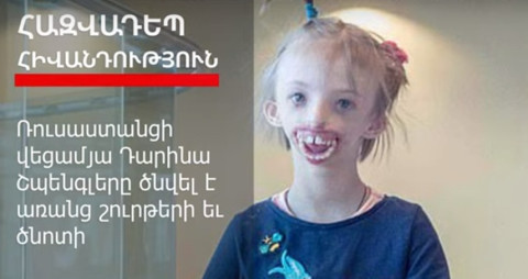 Առանց շուրթերի եւ ծնոտի ծնված աղջիկը պատրաստվում է վիրահատության