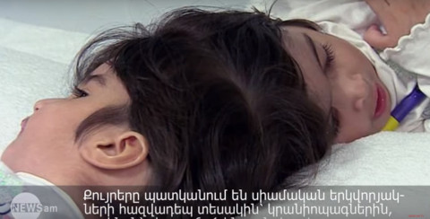 Սիամական երկվորյակներին բաժանել են 55 ժամ տեւած վիրահատությամբ