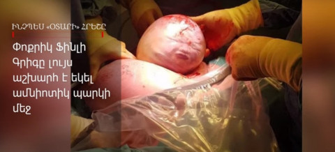 Անգլիայում երեխան ծնվել է «շապիկի» մեջ